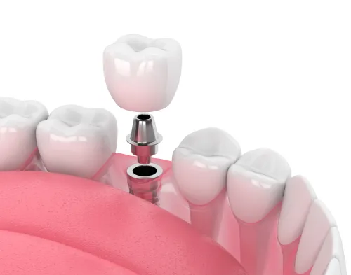 Dental Implants